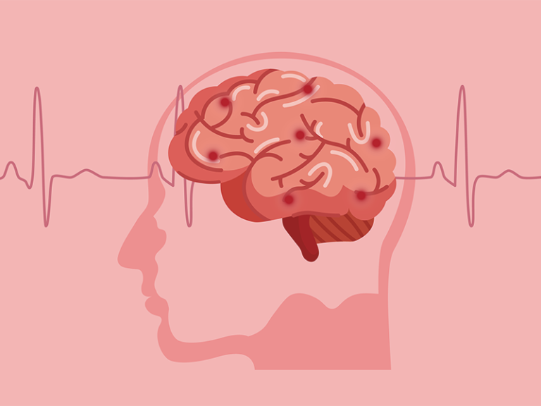 【バットで殴られたような人生最悪な痛み】脳卒中とは？症状、予防のポイントまで解説